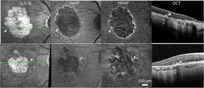 Long Term Time-Lapse Imaging of Geographic Atrophy: A Pilot Study